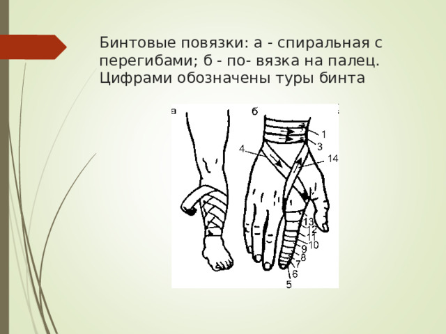 Бинтовые повязки: а - спиральная с перегибами; б - по- вязка на палец. Цифрами обозначены туры бинта