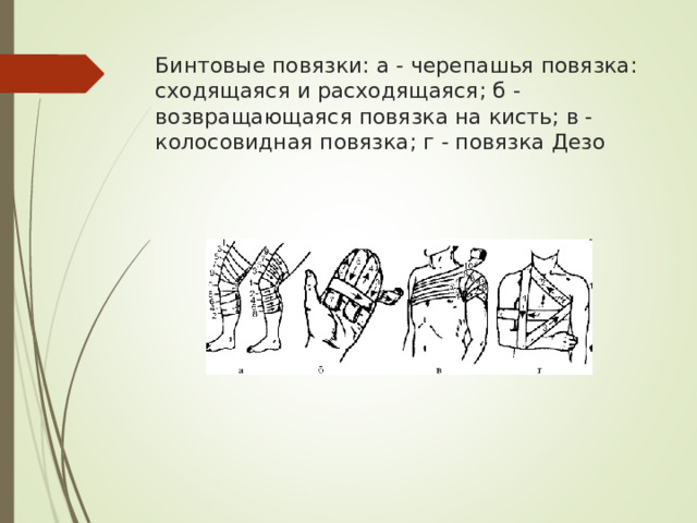 Бинтовые повязки: а - черепашья повязка: сходящаяся и расходящаяся; б - возвращающаяся повязка на кисть; в - колосовидная повязка; г - повязка Дезо