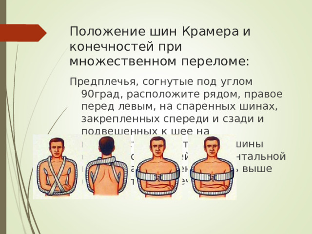 Положение шин Крамера и конечностей при множественном переломе: Предплечья, согнутые под углом 90град, расположите рядом, правое перед левым, на спаренных шинах, закрепленных спереди и сзади и подвешенных к шее на перекрестных бинтах. Обе шины фиксируют третьей, горизонтальной шиной, расположенной чуть выше средней трети плеча.