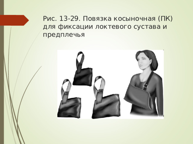 Рис. 13-29. Повязка косыночная (ПК) для фиксации локтевого сустава и предплечья