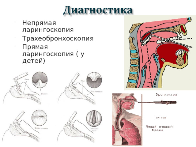 Непрямая ларингоскопия Трахеобронхоскопия Прямая ларингоскопия ( у детей)