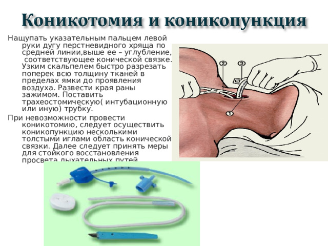 Нащупать указательным пальцем левой руки дугу перстневидного хряща по средней линии,выше ее – углубление, соответствующее конической связке. Узким скальпелем быстро разрезать поперек всю толщину тканей в пределах ямки до проявления воздуха. Развести края раны зажимом. Поставить трахеостомическую( интубационную или иную) трубку. При невозможности провести коникотомию, следует осуществить коникопункцию несколькими толстыми иглами область конической связки. Далее следует принять меры для стойкого восстановления просвета дыхательных путей.