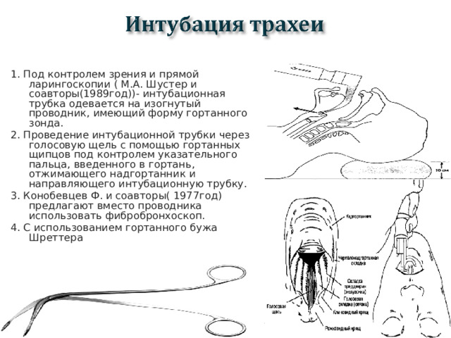 1. Под контролем зрения и прямой ларингоскопии ( М.А. Шустер и соавторы(1989год))- интубационная трубка одевается на изогнутый проводник, имеющий форму гортанного зонда. 2. Проведение интубационной трубки через голосовую щель с помощью гортанных щипцов под контролем указательного пальца, введенного в гортань, отжимающего надгортанник и направляющего интубационную трубку. 3. Конобевцев Ф. и соавторы( 1977год) предлагают вместо проводника использовать фибробронхоскоп. 4. С использованием гортанного бужа Шреттера