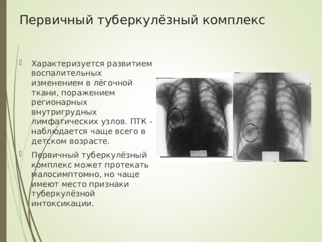 Первичный туберкулёзный комплекс