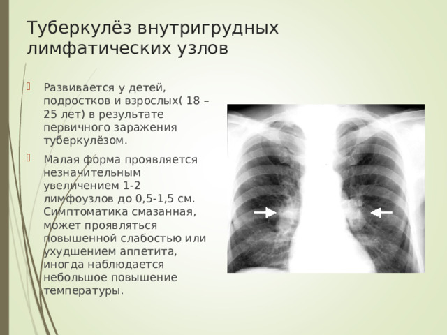 Туберкулёз внутригрудных лимфатических узлов