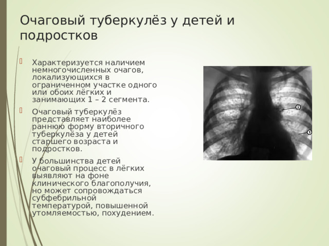 Очаговый туберкулёз у детей и подростков
