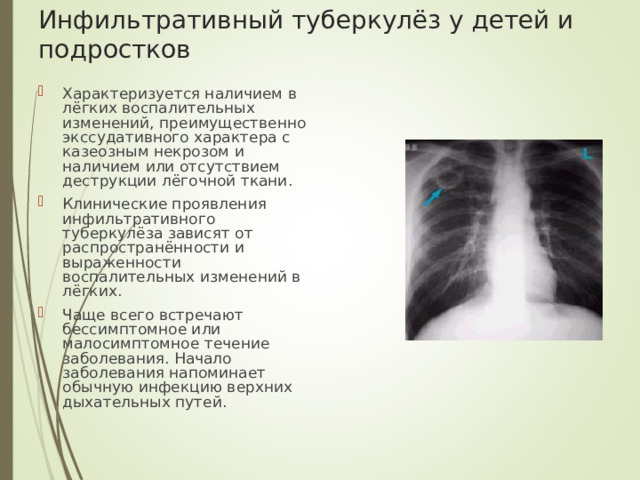 Инфильтративный туберкулёз у детей и подростков