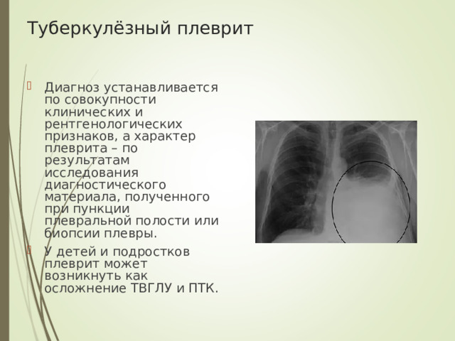 Туберкулёзный плеврит