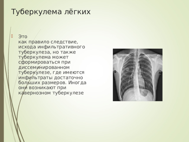 Туберкулема лёгких