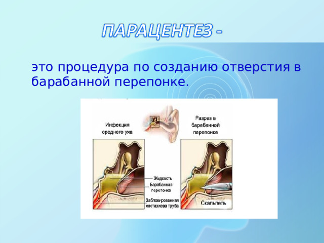 это процедура по созданию отверстия в барабанной перепонке.