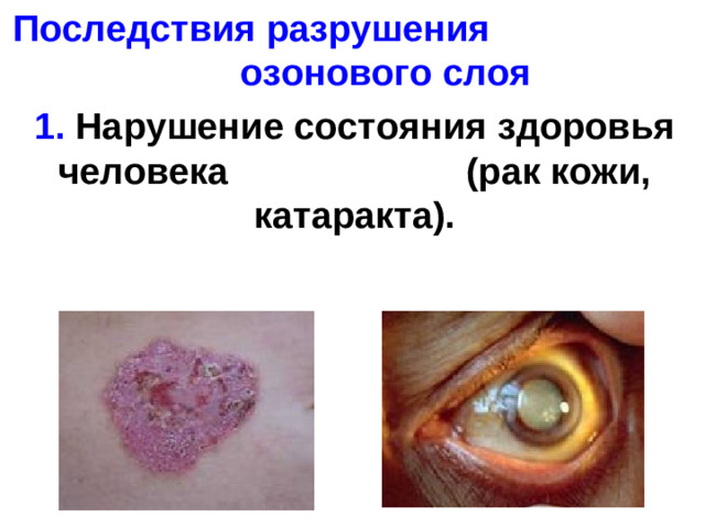 Последствия разрушения озонового слоя 1. Нарушение состояния здоровья человека (рак кожи, катаракта).  
