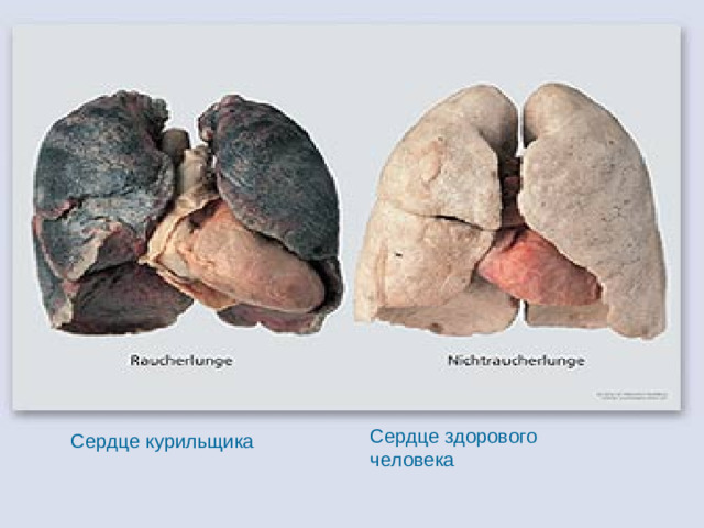 Сердце здорового человека Сердце курильщика