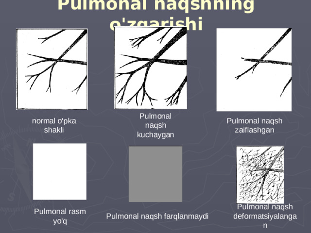 Pulmonal naqshning o'zgarishi Pulmonal naqsh kuchaygan normal o'pka shakli Pulmonal naqsh zaiflashgan Pulmonal naqsh deformatsiyalangan Pulmonal rasm yo'q Pulmonal naqsh farqlanmaydi