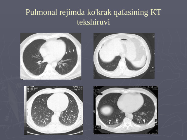 Pulmonal rejimda ko'krak qafasining KT tekshiruvi