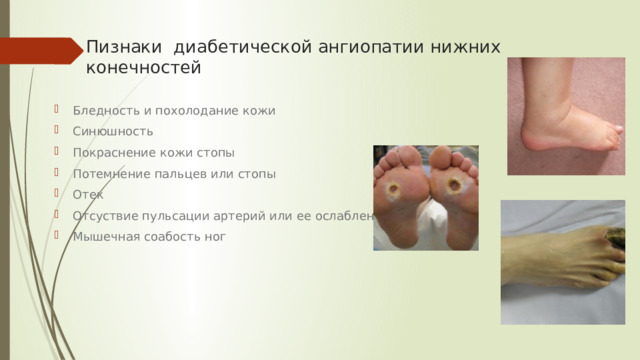 Пизнаки диабетической ангиопатии нижних конечностей