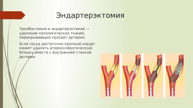 Эндартерэктомия Тромбэктомия и эндартерэктомия — удаление патологических тканей, перекрывающих просвет артерии; Если сосуд достаточно крупный,хирург может удалить атеросклеротическую бляшку вместе с внутренней стенкой артерии