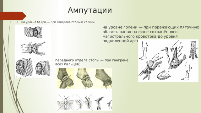 Ампутации . . на уровне бедра — при гангрене стопы и голени. на уровне бедра — при гангрене стопы и голени. на уровне голени — при поражающих пяточную область ранах на фоне сохранённого магистрального кровотока до уровня подколенной артерии переднего отдела стопы — при гангрене всех пальцев;