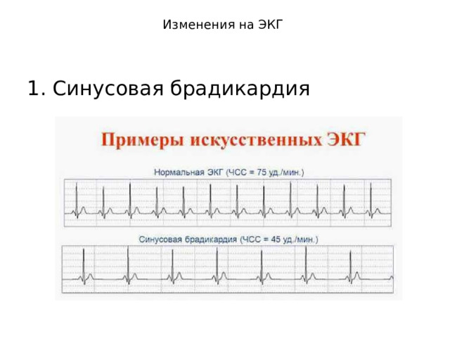 Изменения на ЭКГ   1. Синусовая брадикардия