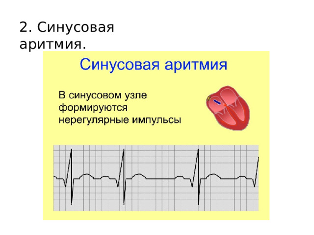 2. Синусовая аритмия.