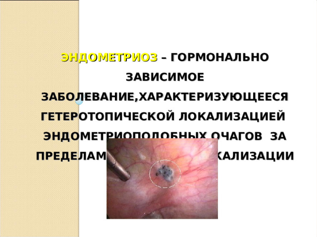 ЭНДОМЕТРИОЗ – ГОРМОНАЛЬНО ЗАВИСИМОЕ ЗАБОЛЕВАНИЕ,ХАРАКТЕРИЗУЮЩЕЕСЯ ГЕТЕРОТОПИЧЕСКОЙ ЛОКАЛИЗАЦИЕЙ ЭНДОМЕТРИОПОДОБНЫХ ОЧАГОВ ЗА ПРЕДЕЛАМИ ТИПИЧНОЙ ЛОКАЛИЗАЦИИ ЭНДОМЕТРИЯ.
