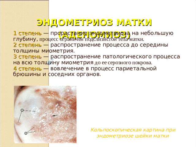 ЭНДОМЕТРИОЗ МАТКИ (АДЕНОМИОЗ)   1 степень — прорастание эндометриоза на небольшую глубину ,  процесс ограничен подслизистой тела матки. 2 степень — распространение процесса до середины толщины миометрия. 3 степень — распространение патологического процесса на всю толщину миометрия  до ее серозного покрова. 4 степень — вовлечение в процесс париетальной брюшины и соседних органов. Кольпоскопическая картина при эндометриозе шейки матки