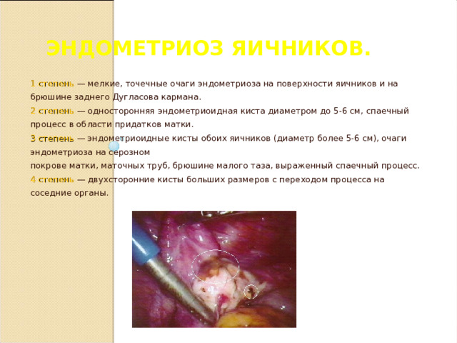ЭНДОМЕТРИОЗ ЯИЧНИКОВ. 1 степень — мелкие, точечные очаги эндометриоза на поверхности яичников и на брюшине заднего Дугласова кармана. 2 степень  — односторонняя эндометриоидная киста диаметром до 5-6 см, спаечный процесс в области придатков матки. 3 степень — эндометриоидные кисты обоих яичников (диаметр более 5-6 см), очаги эндометриоза на серозном покрове матки, маточных труб, брюшине малого таза, выраженный спаечный процесс. 4 степень — двухсторонние кисты больших размеров с переходом процесса на соседние органы.