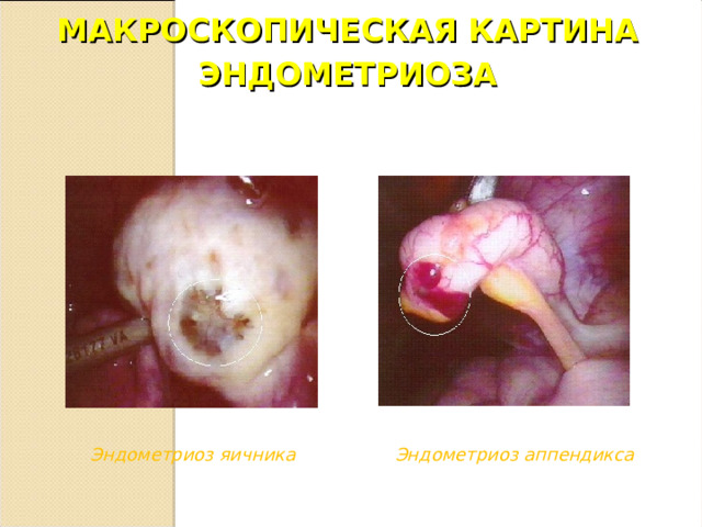 МАКРОСКОПИЧЕСКАЯ КАРТИНА ЭНДОМЕТРИОЗА Эндометриоз яичника Эндометриоз аппендикса