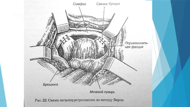 Берча