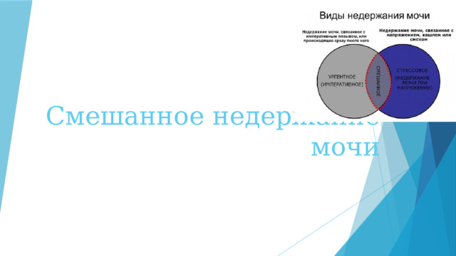 Смешанное недержание мочи