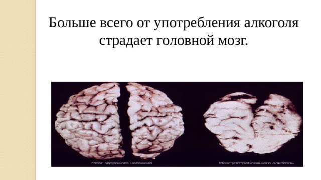 Больше всего от употребления алкоголя страдает головной мозг.