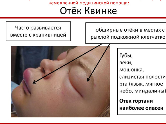 Самое серьезное проявление аллергической реакции, которое требует немедленной медицинской помощи: