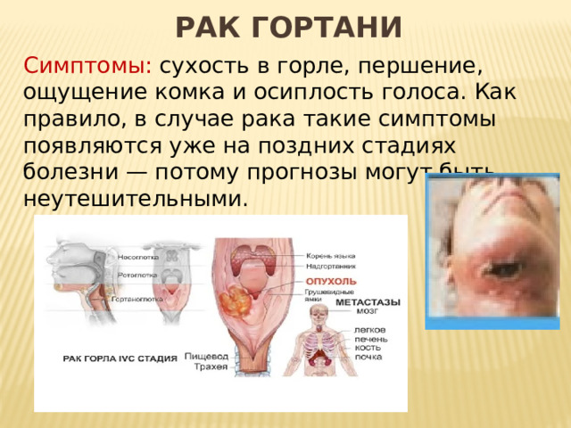 Рак гортани Симптомы: сухость в горле, першение, ощущение комка и осиплость голоса. Как правило, в случае рака такие симптомы появляются уже на поздних стадиях болезни — потому прогнозы могут быть неутешительными.