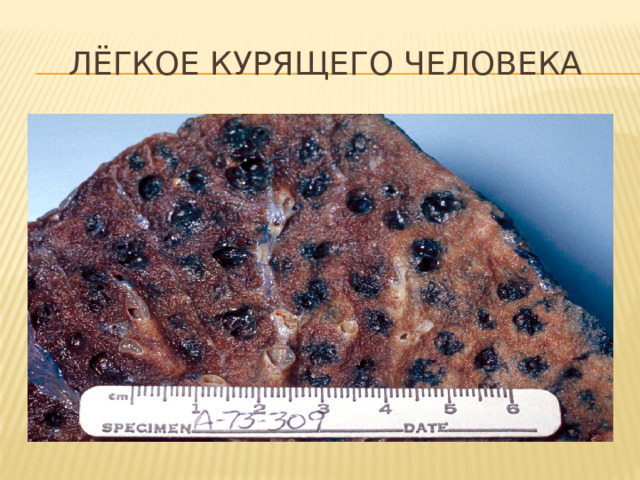 Лёгкое курящего человека