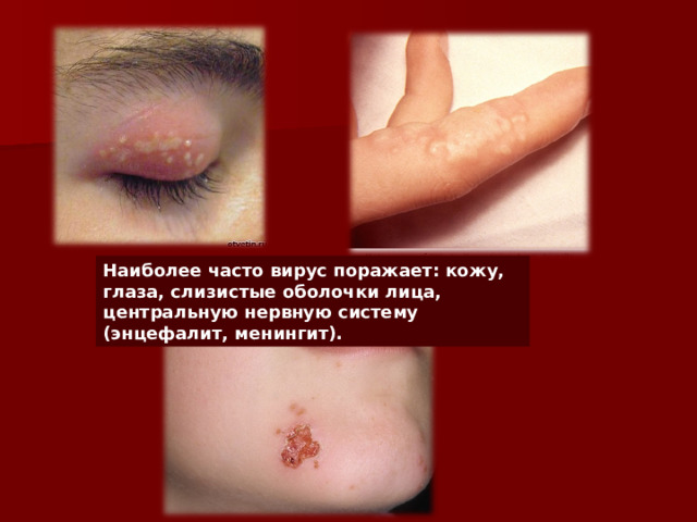 Наиболее часто вирус поражает: кожу, глаза, слизистые оболочки лица, центральную нервную систему (энцефалит, менингит).