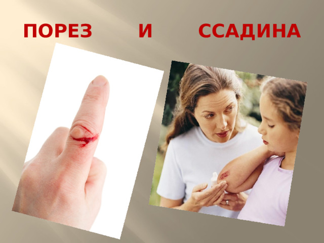 ПОРЕЗ И ССАДИНА