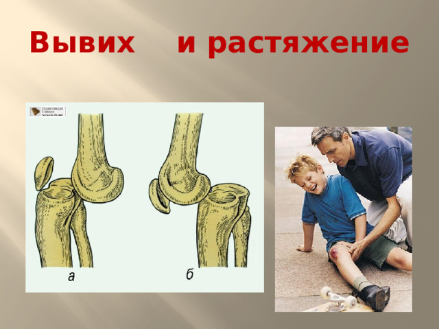 Вывих и растяжение