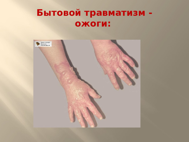 Бытовой травматизм -  ожоги: