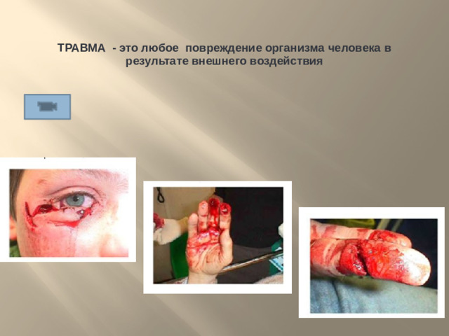 ТРАВМА - это любое повреждение организма человека в результате внешнего воздействия