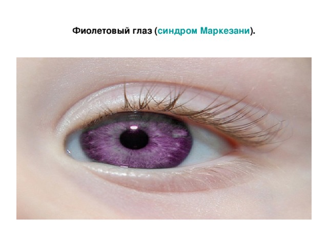 Фиолетовый глаз ( синдром Маркезани ).