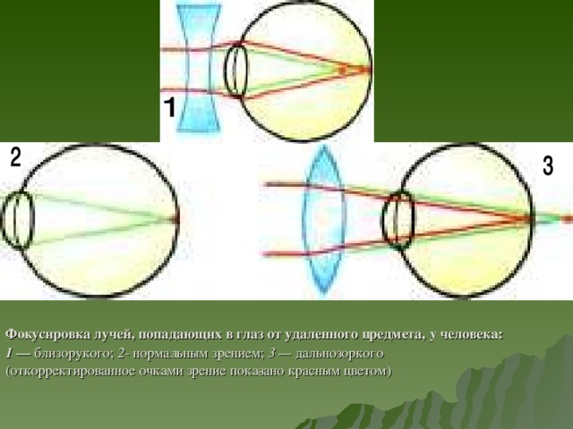 Фокусировка лучей, попадающих в глаз от удаленного предмета, у человека: 1 — близорукого; 2- нормальным зрением; 3 — дальнозоркого (откорректированное очками зрение пока­зано красным цветом)
