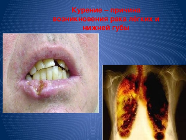 Курение – причина возникновения рака лёгких и нижней губы
