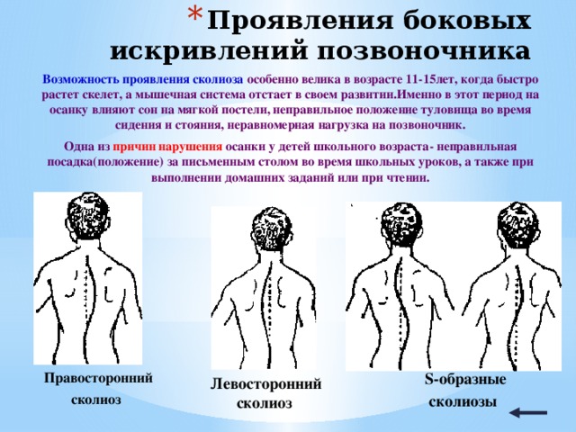 Проект по биологии сколиоз 9 класс