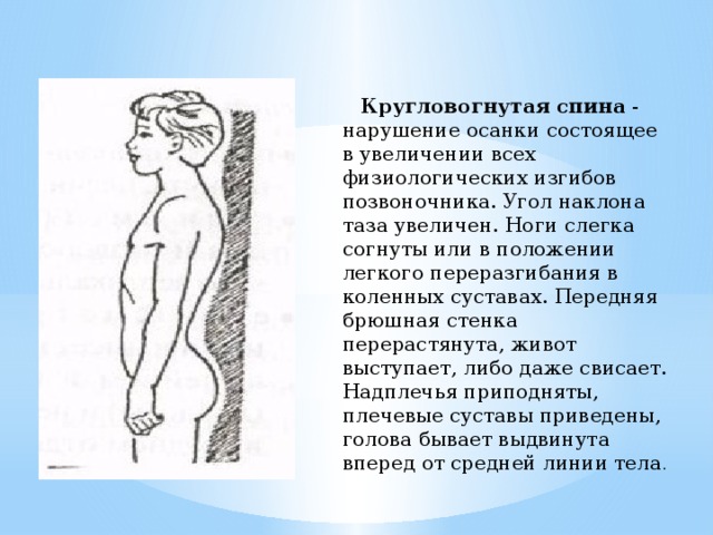 Кругловогнутая спина - нарушение осанки состоящее в увеличении всех физиологических изгибов позвоночника. Угол наклона таза увеличен. Ноги слегка согнуты или в положении легкого переразгибания в коленных суставах. Передняя брюшная стенка перерастянута, живот выступает, либо даже свисает. Надплечья приподняты, плечевые суставы приведены, голова бывает выдвинута вперед от средней линии тела .