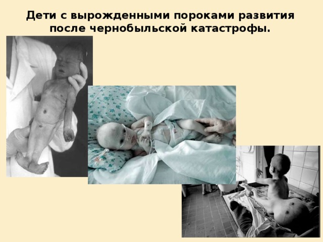 Дети с вырожденными пороками развития после чернобыльской катастрофы.