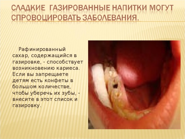 Кариес  Рафинированный сахар, содержащийся в газировке, - способствует возникновению кариеса. Если вы запрещаете детям есть конфеты в большом количестве, чтобы уберечь их зубы, - внесите в этот список и газировку.