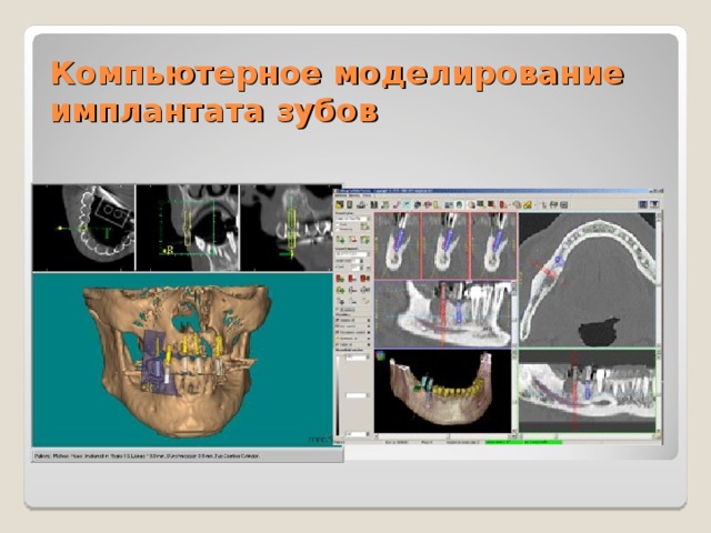 Компьютерное моделирование имплантата зубов