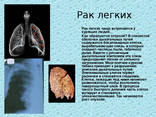 Рак легких  Рак легких чаще встречается у курящих людей.  Как образуются опухоли? В слизистой оболочке дыхательных путей содержатся бокаловидные клетки, вырабатывающие слизь, в которых оседают частицы пыли, табачного дыма. Вместе с ресничным дыхательным эпителием эта слизь предохраняет лёгкие от сильного загрязнения. Многолетнее курение табака приводит к разрушению эпителия дыхательных путей. Эпителиальные клетки теряют реснички и становятся гладкими. Клетки, лежащие под ними начинают размножаться, чтобы восполнить поверхностный слой. В процессе такого быстрого деления часть клеток мутирует и становится злокачественными. Так начинается рост опухоли.