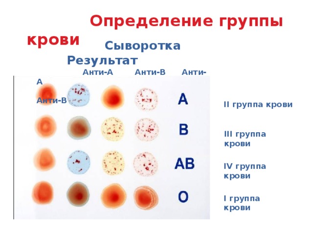 Определение группы крови  Сыворотка Результат  Анти-А Анти-В Анти-А  Анти-В II группа крови III группа крови IV группа крови I группа крови