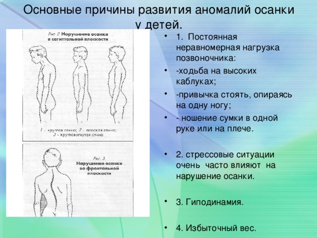 Главная причина нарушения осанки