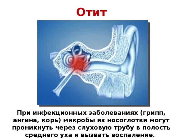 Отит При инфекционных заболеваниях (грипп, ангина, корь) микробы из носоглотки могут проникнуть через слуховую трубу в полость среднего уха и вызвать воспаление.